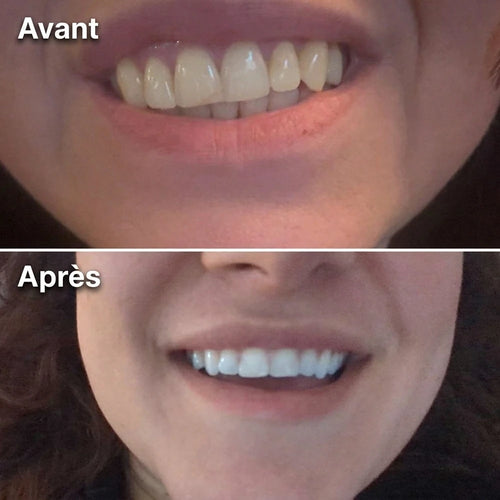 Avant / Après — dents avant et après utilisation