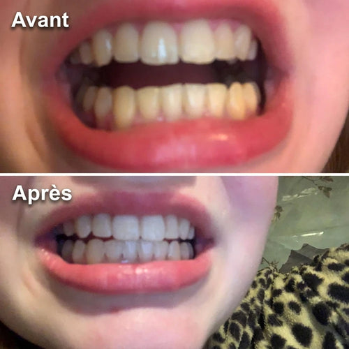 Avant / Après — dents avant et après utilisation