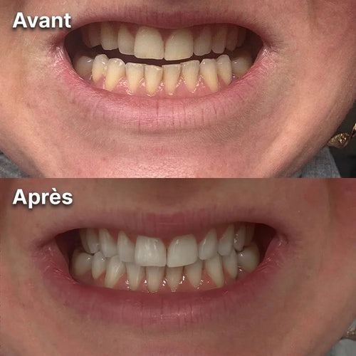Avant / Après — dents avant et après utilisation