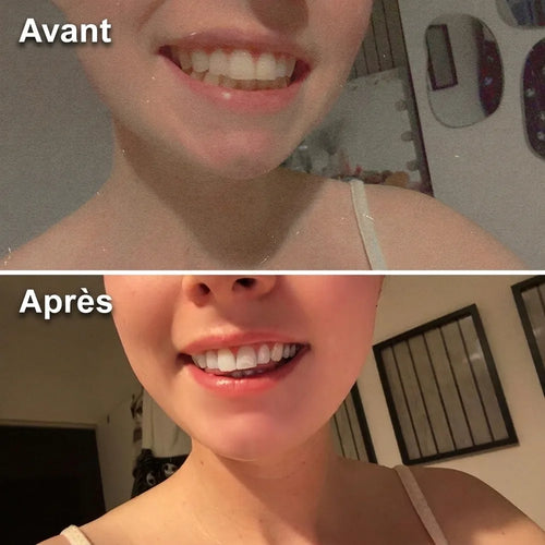 Avant / Après — dents avant et après utilisation