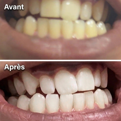 Avant / Après — dents avant et après utilisation