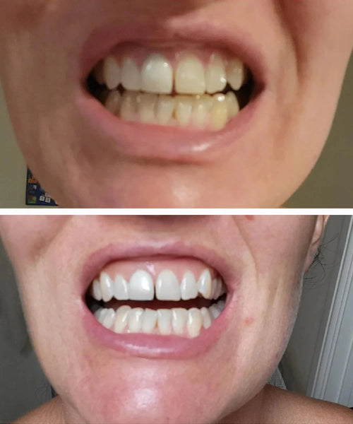 Avant / Après — sourire avant et après utilisation