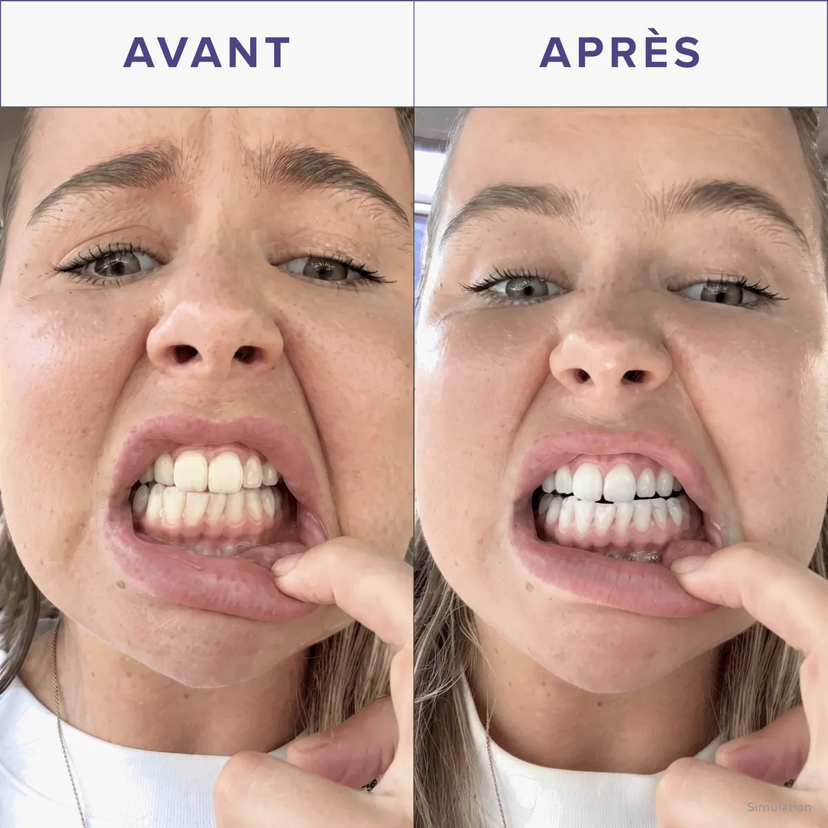 Avant / après sur les dents — simulation